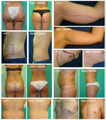 HIDROLIPOCLASIA